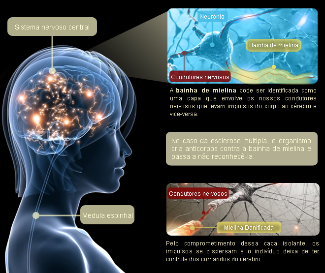 infografico-esclerose-multipla.jpg