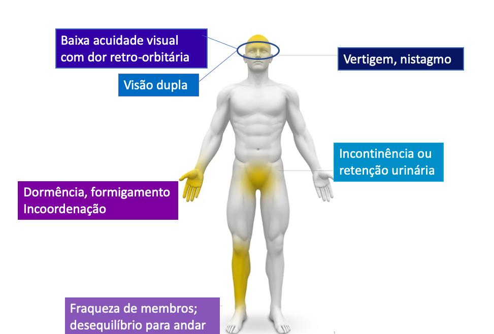 6 sintomas iniciais e surpreendentes da Esclerose Múltipla