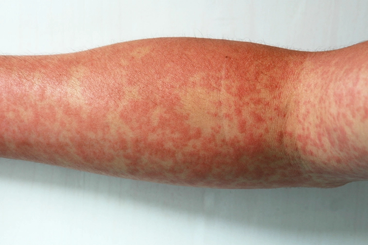 Pele do braço com manchas vermelhas, sintoma da dengue