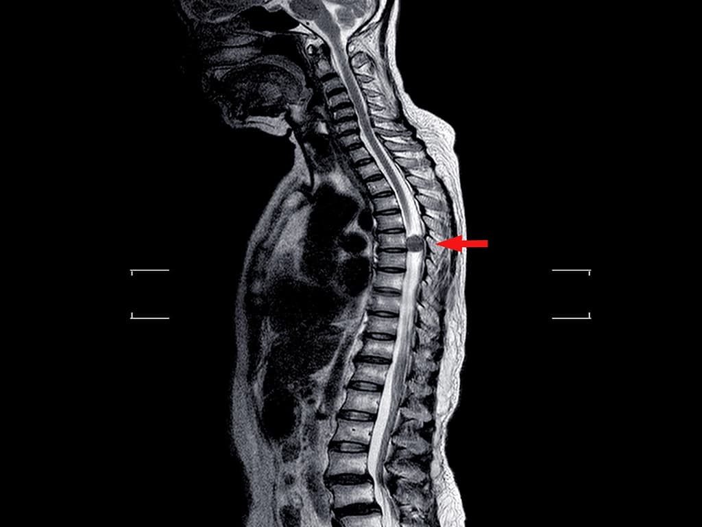Figura que mostra o esqueleto de uma pessoa de perfil, e destaca, com uma seta vermelha, a lesão na medula na coluna.