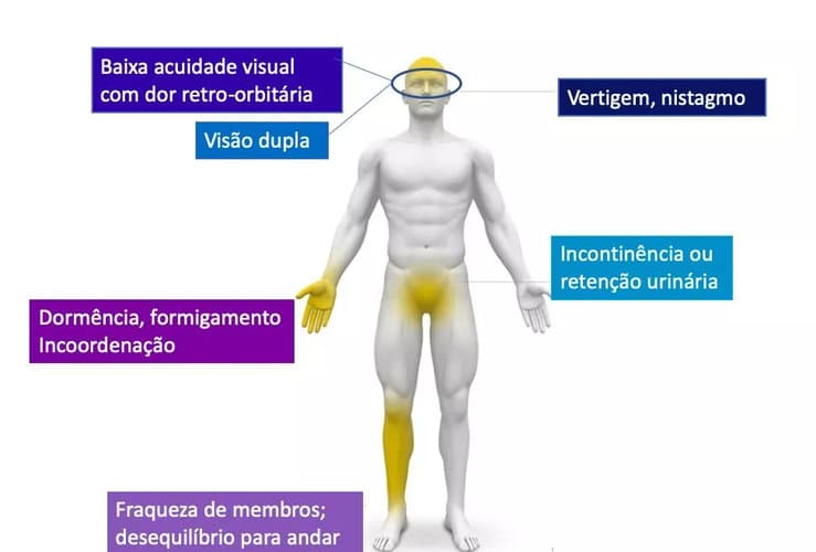 Ilustração dos sintomas e sinais da esclerose múltipla (EM): baixa acuidade visual com dor retro-orbitária; vertigem e nistagmo; visão dupla; incontinência ou retenção urinária; dormência e formigamento; incoordenação; fraqueza nos membros; e desequilíbrio ao andar.