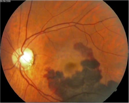 Exame de imagem para constatação da DMRI. Nesta imagem é possível constatar a DMRI Úmida ou exsudativa, a forma mais grave da doença. É possível ver a formação de vasos anormais embaixo da retina.