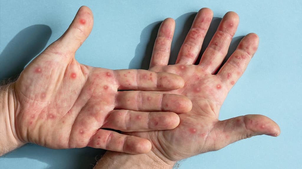 A imagem mostra mãos humanas com bolhas na pele, as quais aparecem como um dos sinais da doença causada pelo Mpox virus
