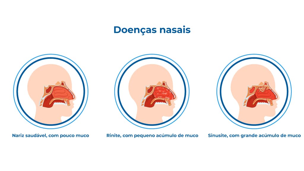 Ilustração comparativa de um nariz saudável, rinite com pequeno acúmulo de muco e sinusite com grande acúmulo. Essas condições podem causar congestão nasal, também chamado nariz entupido, dificultando a respiração
