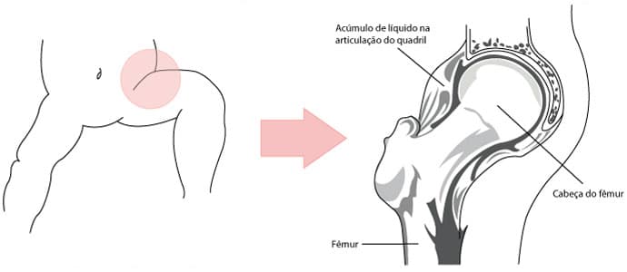 Ilustração do quadril de uma criança, que está localizado entre a bacia e a coxa, com detalhes sobre o acúmulo de líquido na articulação do quadril e indicações da localização da cabeça do osso fêmur.