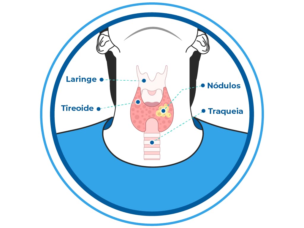 Ilustração do pescoço humano que mostra a localização da laringe, tireoide e traqueia. Ela mostra a região onde o carcinoma ou câncer de tireoide pode se instalar no órgão, que é geralmente percebido por meio de nódulo, dor no pescoço ou tosse constante. Ilustração do pescoço humano que mostra a localização da laringe, tireoide e traqueia. Ela mostra a região onde o carcinoma ou câncer de tireoide pode se instalar no órgão, que é geralmente percebido por meio de nódulo, dor no pescoço ou tosse constante.