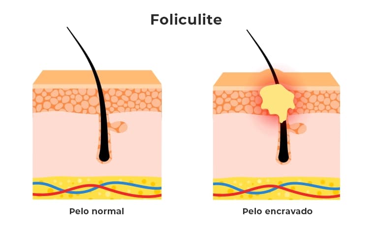 A imagem compara um pelo normal (esquerda), que cresce sem obstruções, com um pelo encravado (direita), que causa inflamação no folículo piloso, resultando em vermelhidão e formação de pus, caracterizando a foliculite.