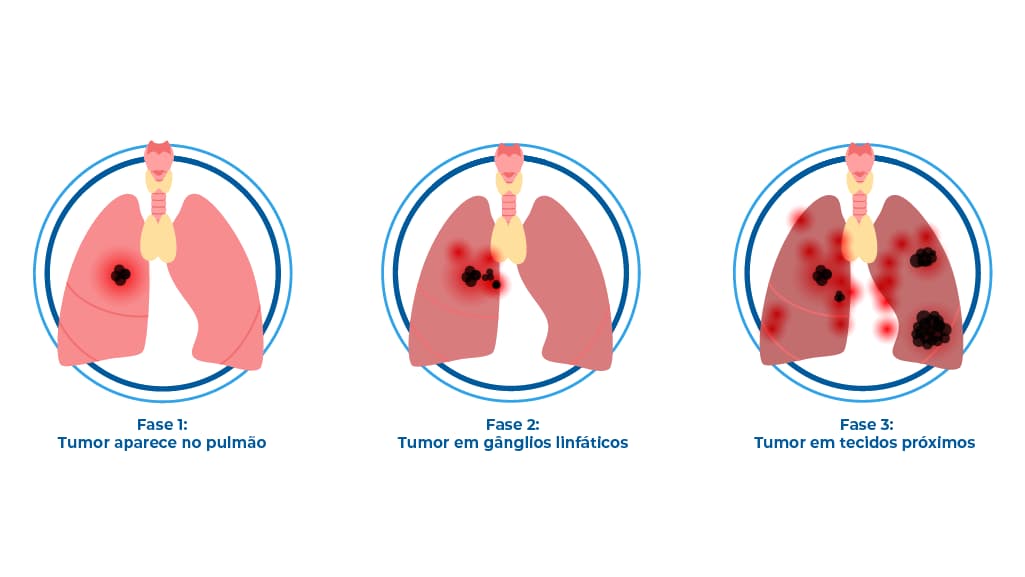 O infográfico mostra os estágios do câncer de colo de útero ou câncer cervical. A imagem mostra o canal cervical normal, e com a doença em diferentes estágios. A condição pode causar dor e sangramento vaginal.