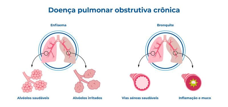 A imagem ilustra a enfisema e a bronquite. Descreve os alvéolos saudáveis e irritados; Vias aéreas saudáveis e inflamação e muco