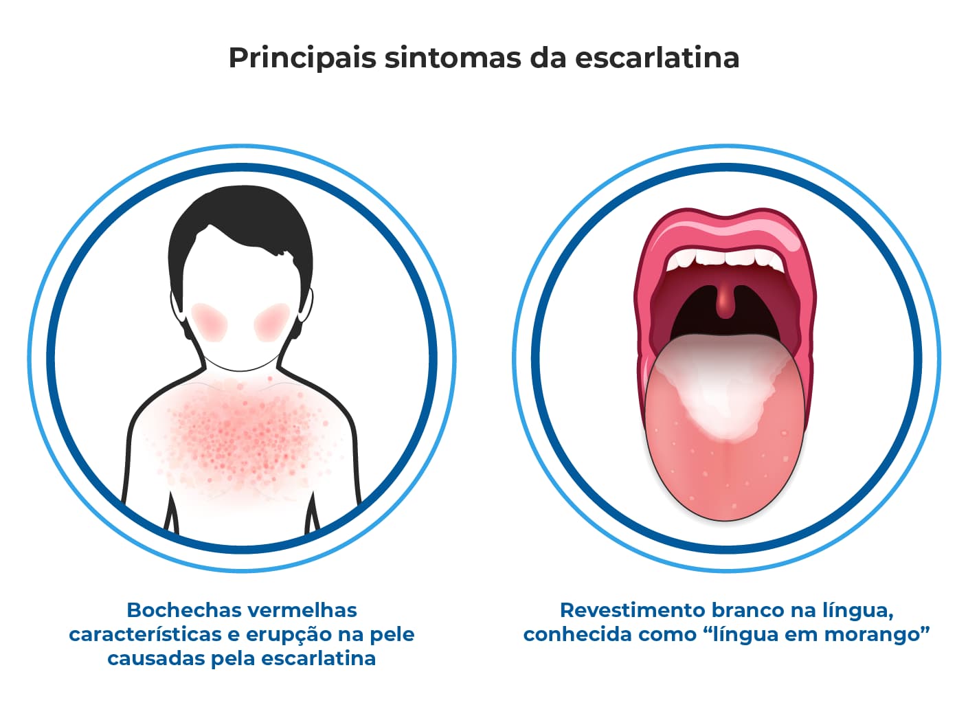 Imagem mostra sintomas de escarlatina: bochechas vermelhas, erupção na pele e língua em morango. Sinais comuns dessa infecção causada por estreptococos e que provoca febre alta. Imagem mostra sintomas de escarlatina: bochechas vermelhas, erupção na pele e língua em morango. Sinais comuns dessa infecção causada por estreptococos e que provoca febre alta.