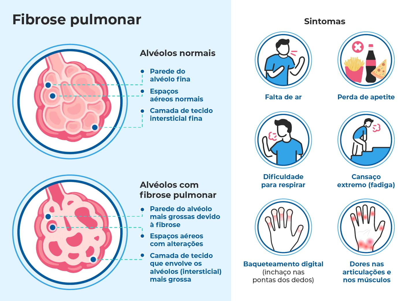 Ilustração médica que mostra pulmões normais e com fibrose pulmonar. Em destaque, os sintomas como falta de ar, perda de peso, cansaço extremo, dores musculares e alterações nos alvéolos pulmonares.