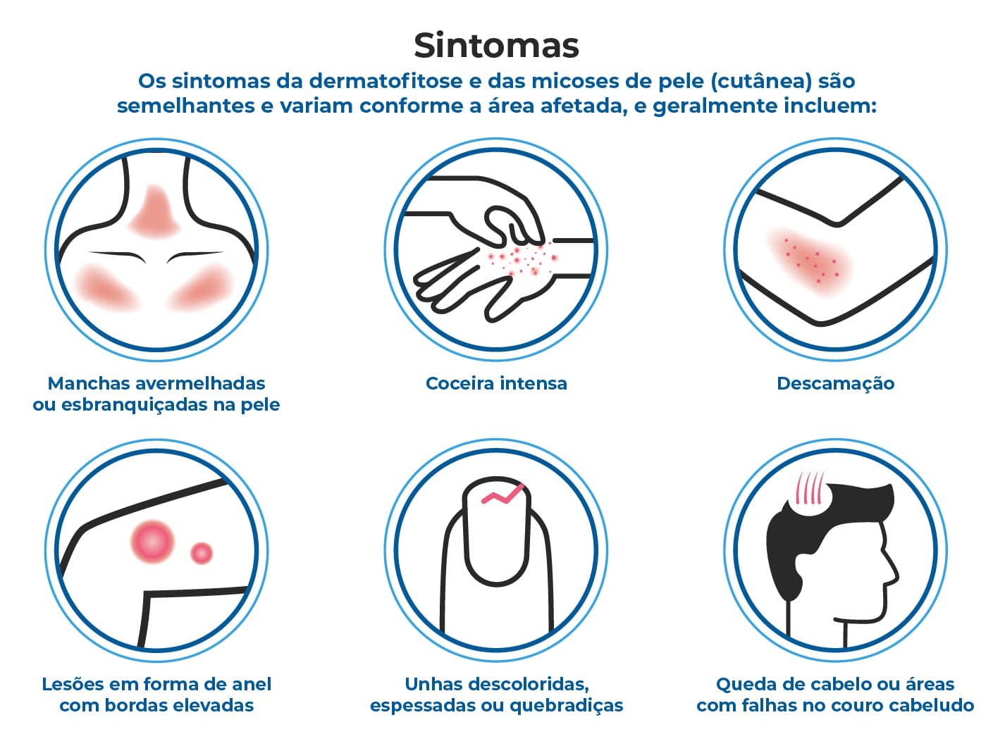 O infográfico apresenta seis sintomas de dermatofitose e micose de pele: coceira intensa, manchas vermelhas, descamação, queda de cabelo, lesões em anel, unhas grossas e esbranquiçadas.