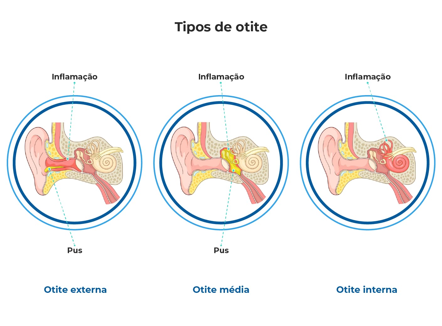 A ilustração mostra os tipos de otite: otite externa, otite média e otite interna, com inflamação e pus. O infográfico apoia o texto que explica o que é otite, os sintomas e causas da infecção de ouvido.
