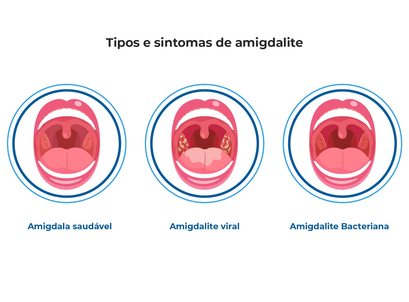Ilustração mostra tipos de amigdalite, como a amigdalite bacteriana e a amigdalite viral e compara com uma amigdala saudável. Apoiam o documento que também explica os sintomas de amigdalite que incluem febre, dor de garganta e pus. Ilustração mostra tipos de amigdalite, como a amigdalite bacteriana e a amigdalite viral e compara com uma amigdala saudável. Apoiam o documento que também explica os sintomas de amigdalite que incluem febre, dor de garganta e pus.