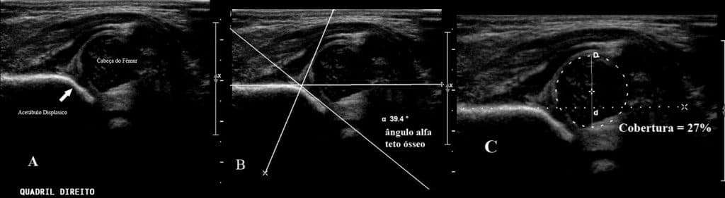 O ultrassom está indicado nos primeiros meses de vida, sendo que após 4-6 meses deixa de ser o exame mais fidedigno (Figura 2 e 3).