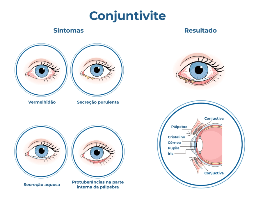 Infográfico com sintomas de conjuntivite, como vermelhidão, secreção purulenta e aquosa, e inflamação da pálpebra. Ilustração anatômica do olho com destaque para a área afetada pela conjuntivite.