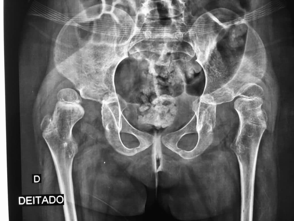 Figura 3 – Radiografia de bacia de criança com paralisia cerebral nível V do GMFCS, com luxação (deslocamento) bilateral dos quadris.