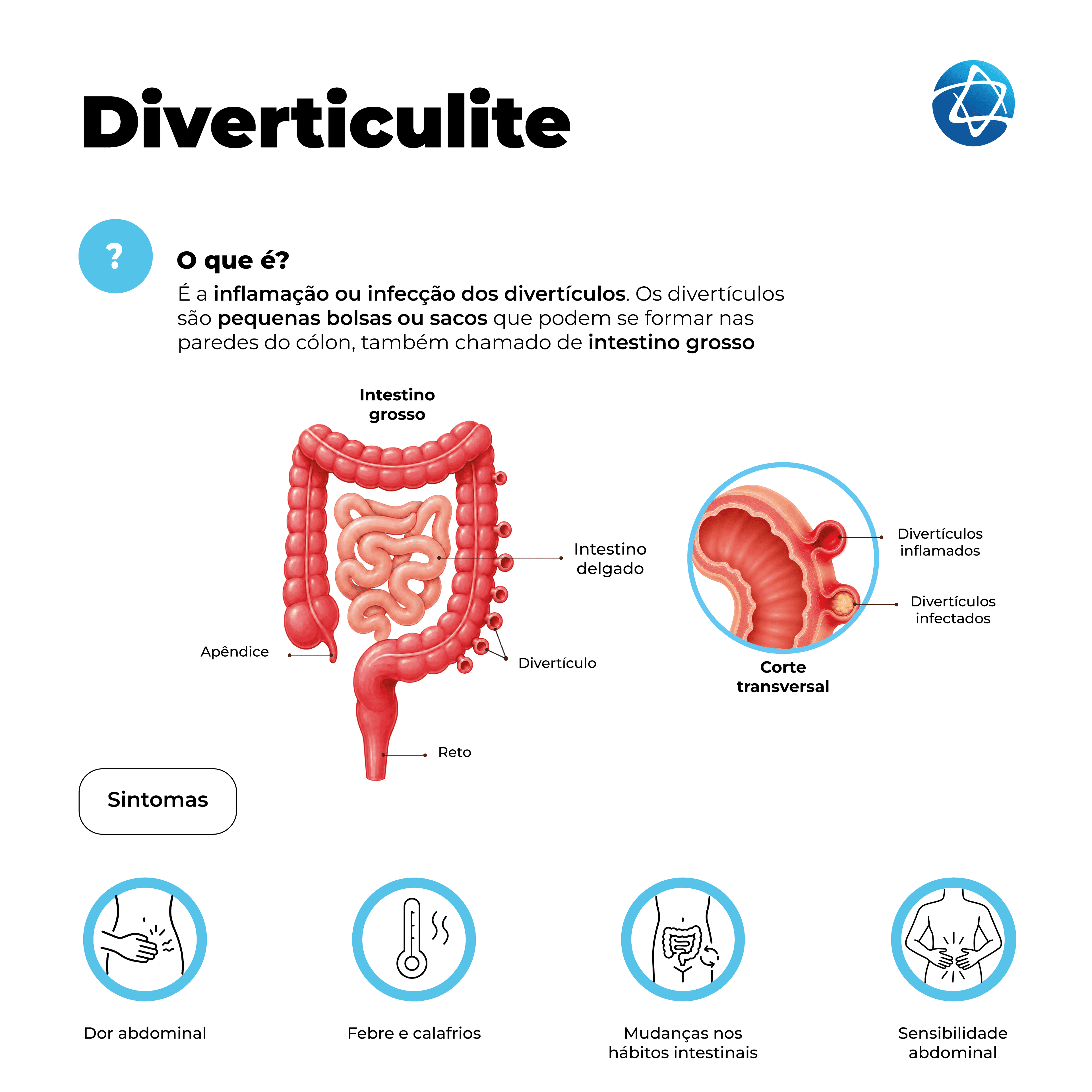 Infográfico sobre diverticulite, explicando que a condição ocorre pela inflamação ou infecção dos divertículos, pequenas bolsas que podem se formar nas paredes do cólon. A imagem mostra o intestino grosso, o intestino delgado e um corte transversal com divertículos inflamados e infectados. Também destaca sintomas comuns, como dor abdominal, febre, calafrios, mudanças nos hábitos intestinais e sensibilidade abdominal.