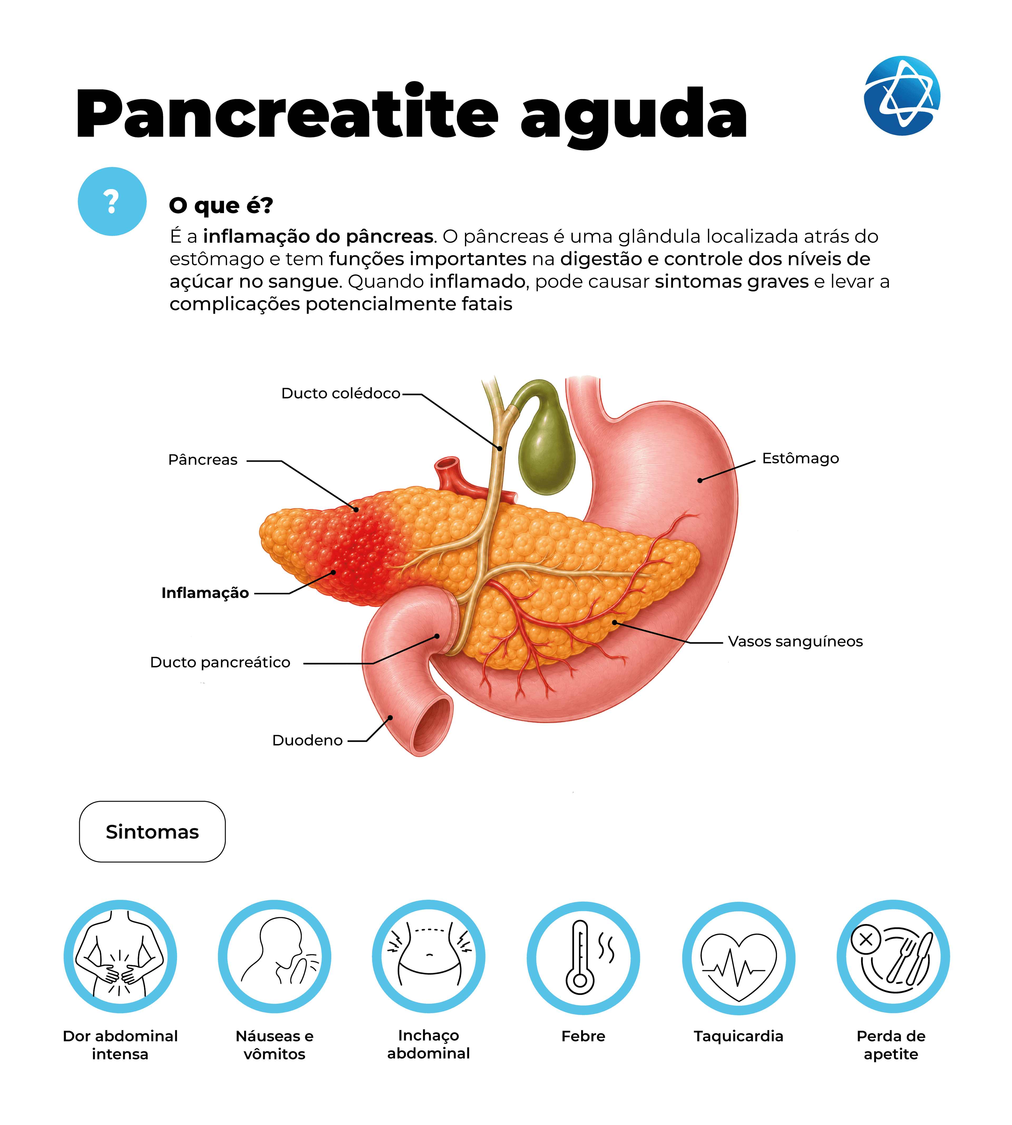 Infográfico sobre pancreatite aguda, explicando que é a inflamação do pâncreas, órgão localizado atrás do estômago e importante para a digestão e controle do açúcar no sangue. A imagem mostra o pâncreas inflamado e estruturas próximas, como estômago, duodeno, ductos e vasos sanguíneos. Também destaca sintomas comuns, como dor abdominal intensa, náuseas, vômitos, inchaço abdominal, febre, taquicardia e perda de apetite.