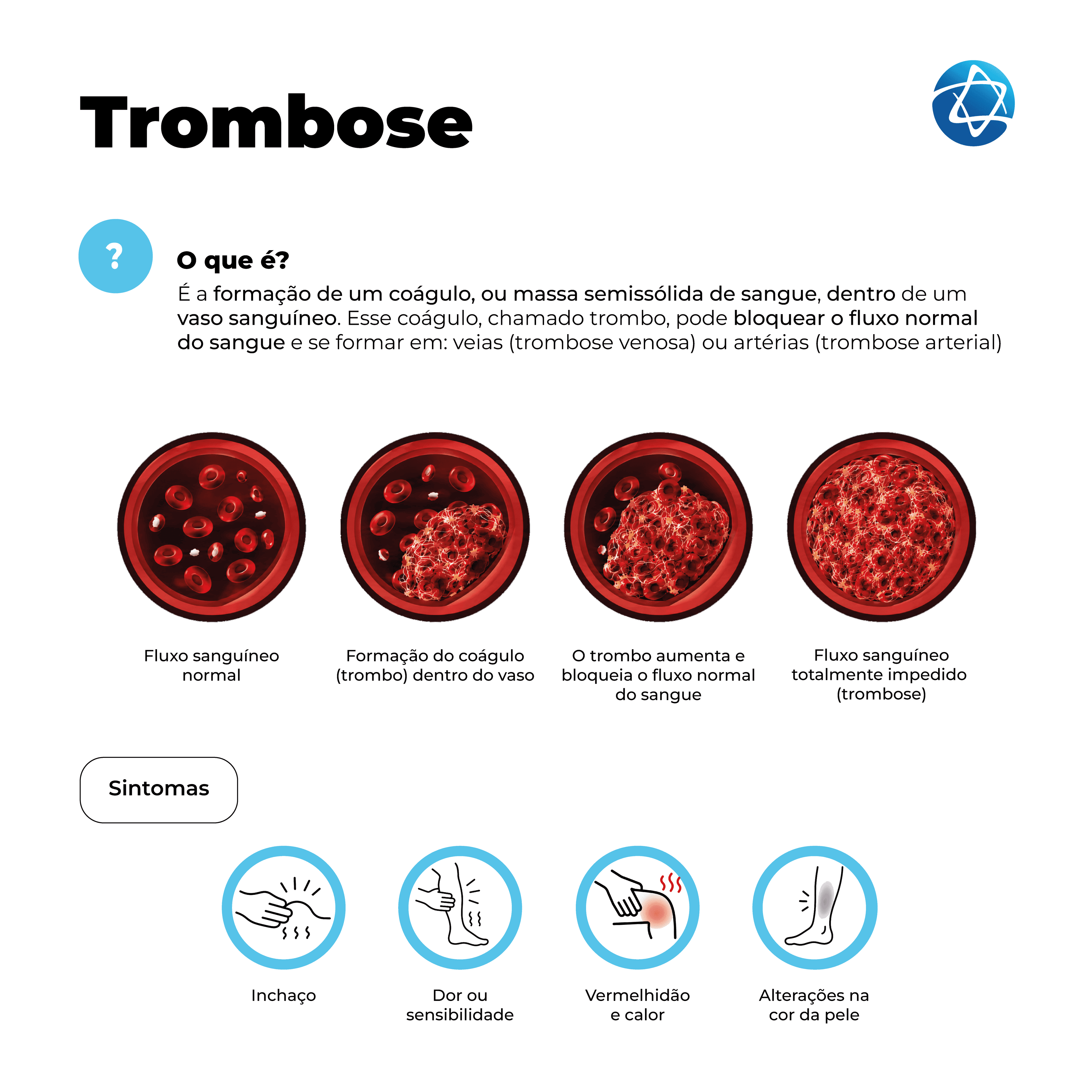 Infográfico sobre trombose, explicando que a condição ocorre pela formação de um coágulo dentro de um vaso sanguíneo, podendo bloquear o fluxo normal do sangue em veias ou artérias. Mostra a evolução do fluxo sanguíneo normal até a obstrução total pelo trombo e destaca sintomas comuns, como inchaço, dor ou sensibilidade, vermelhidão, calor e alterações na cor da pele.