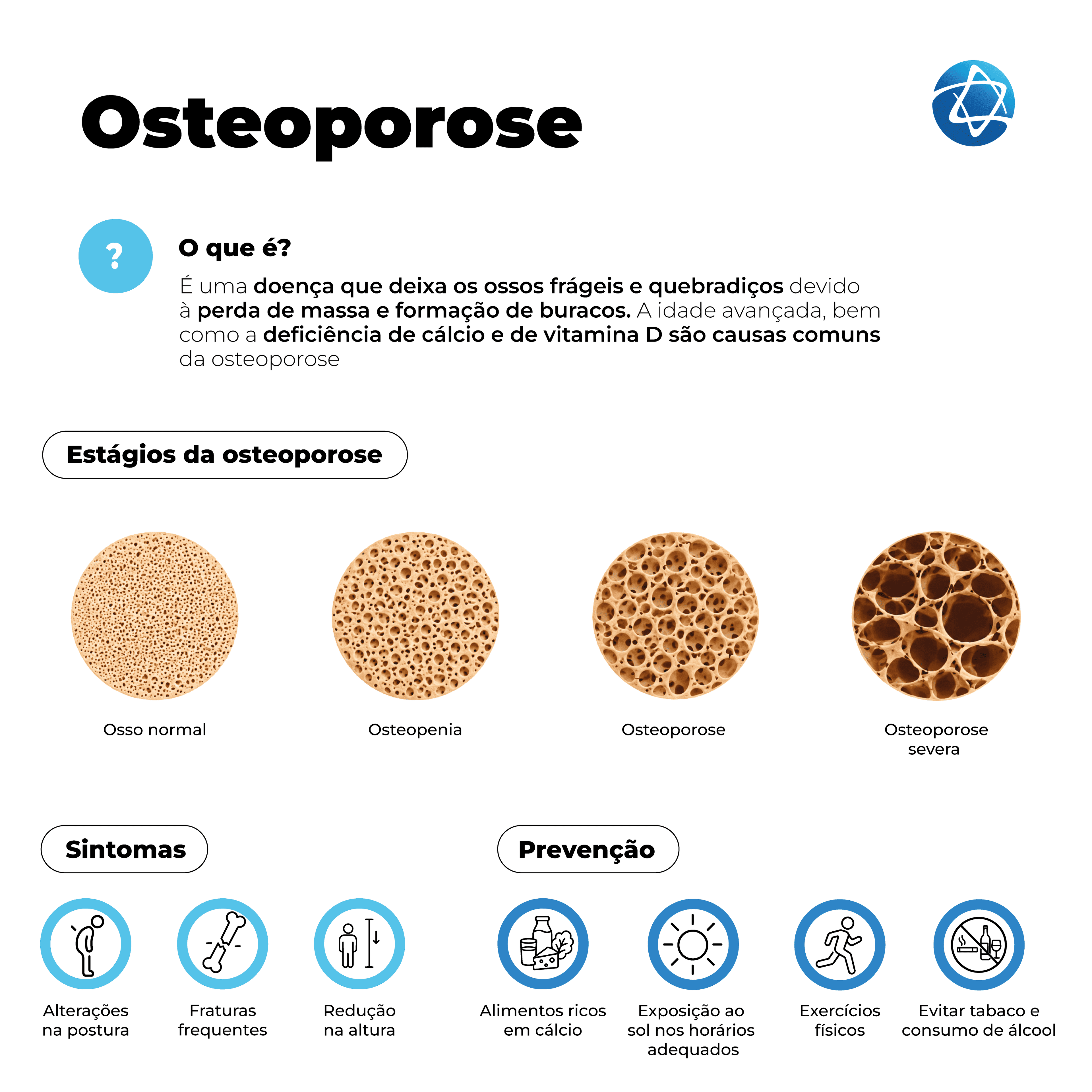 Infográfico sobre osteoporose explicando que a doença deixa os ossos frágeis e quebradiços pela perda de massa óssea. Mostra os estágios da condição, de osso normal a osteoporose severa, sintomas como alterações na postura, fraturas frequentes e redução na altura, além de formas de prevenção.