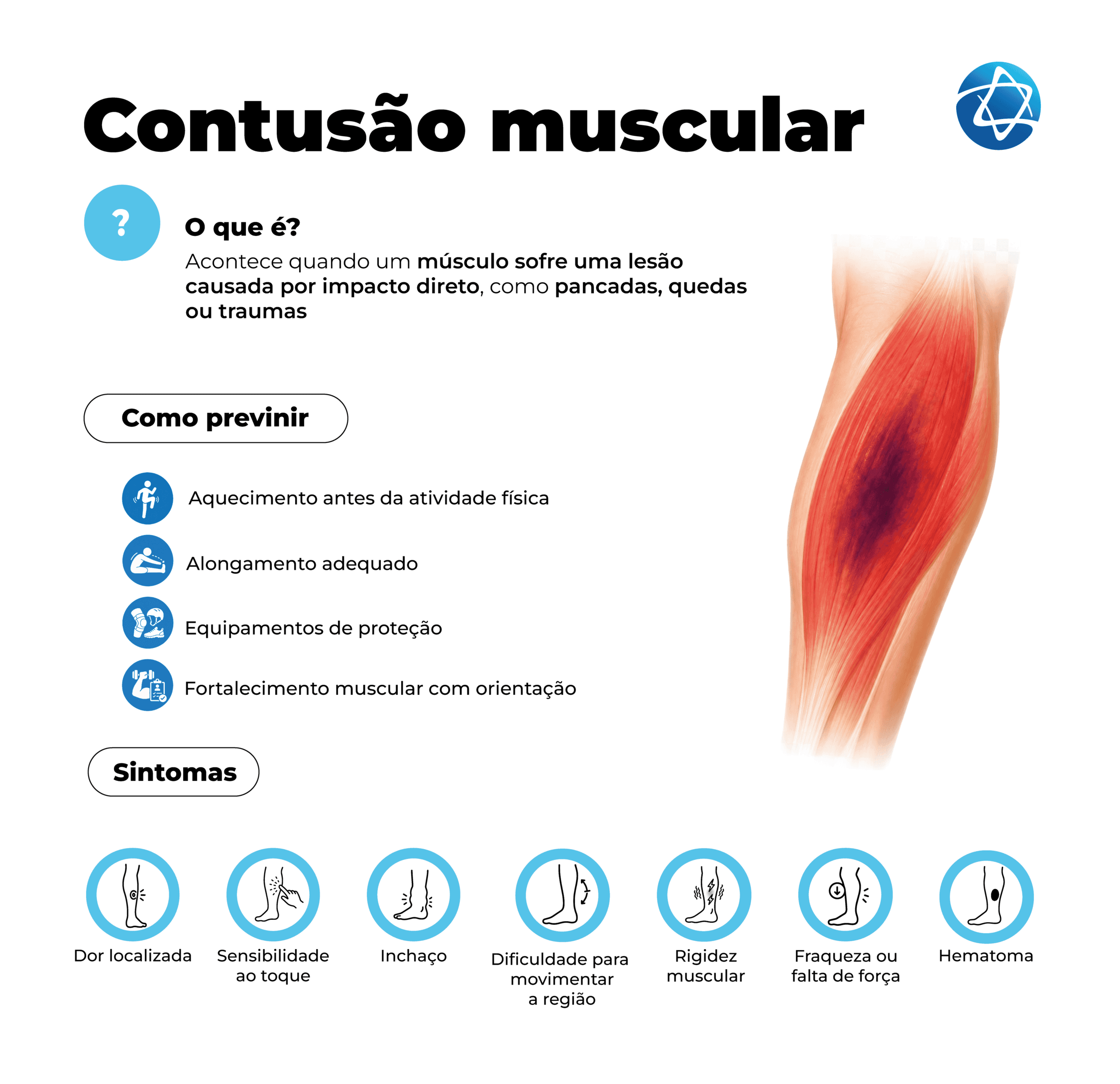 Infográfico sobre contusão muscular explicando que a lesão ocorre quando um músculo sofre impacto direto, como pancadas, quedas ou traumas. Apresenta formas de prevenção, incluindo aquecimento, alongamento, equipamentos de proteção e fortalecimento muscular, além de sintomas como dor localizada, sensibilidade ao toque, inchaço, rigidez, fraqueza e hematoma.