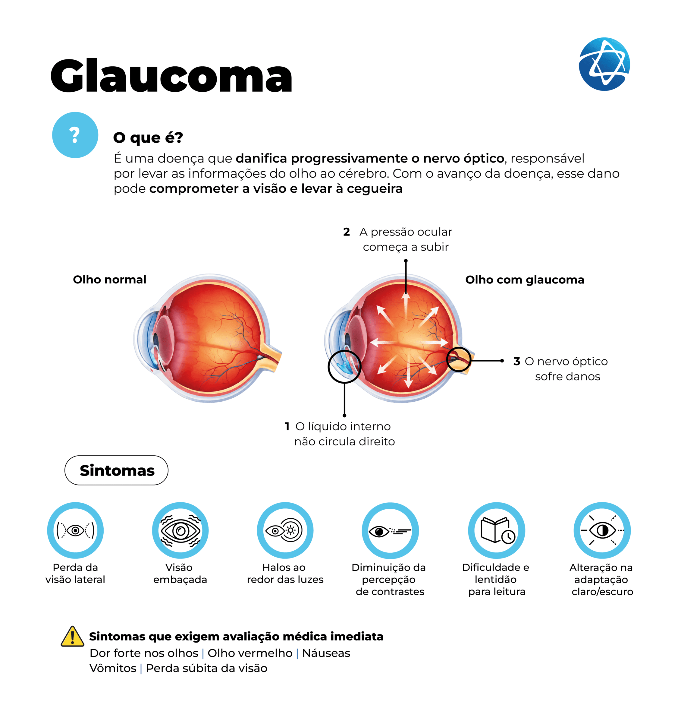 Infográfico sobre glaucoma explicando que a doença danifica progressivamente o nervo óptico e pode comprometer a visão. Compara olho normal e olho com glaucoma, mostrando aumento da pressão ocular e danos no nervo óptico, além de sintomas como perda da visão lateral, visão embaçada, halos ao redor das luzes e dificuldade para leitura.