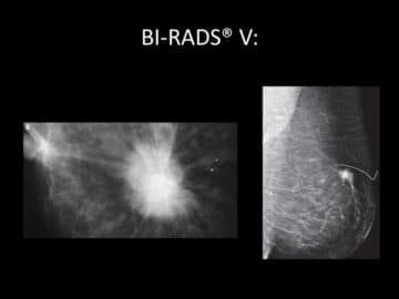birads