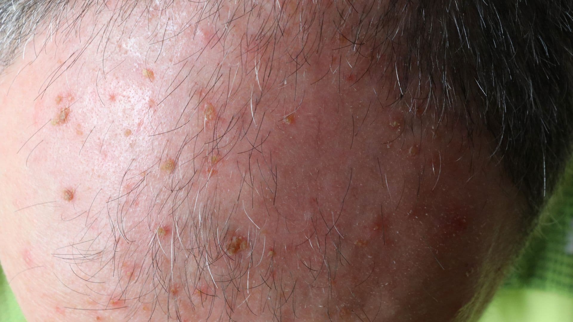ceratose actinica