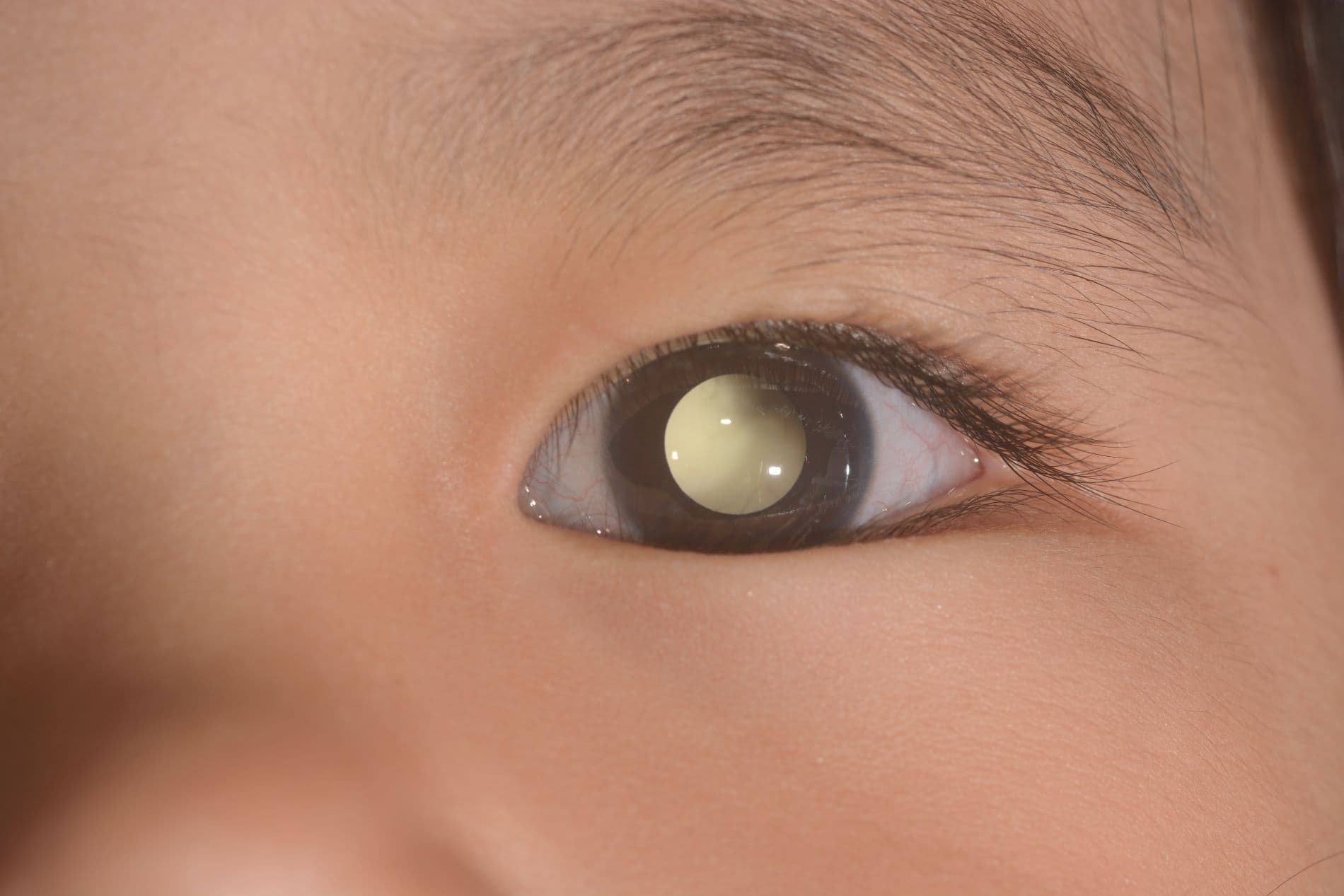 retinoblastoma