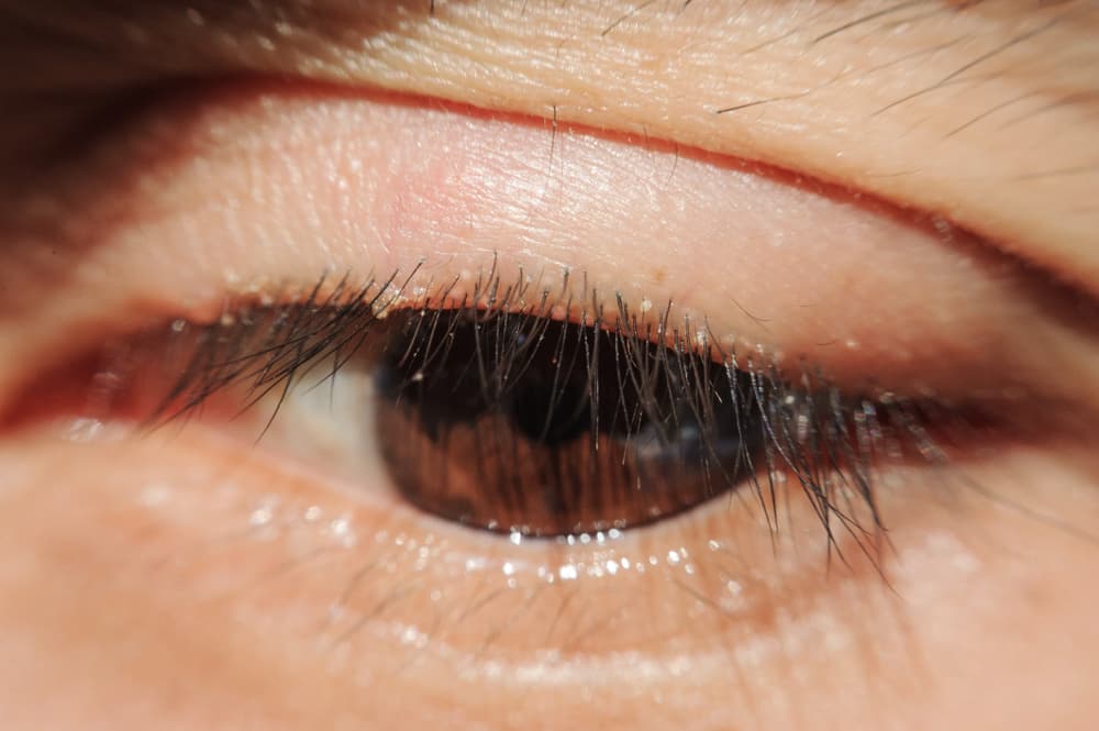 Close,Up,Blepharitis,Or,Eyelid,Inflammation,Healthy,Eyes,Concept