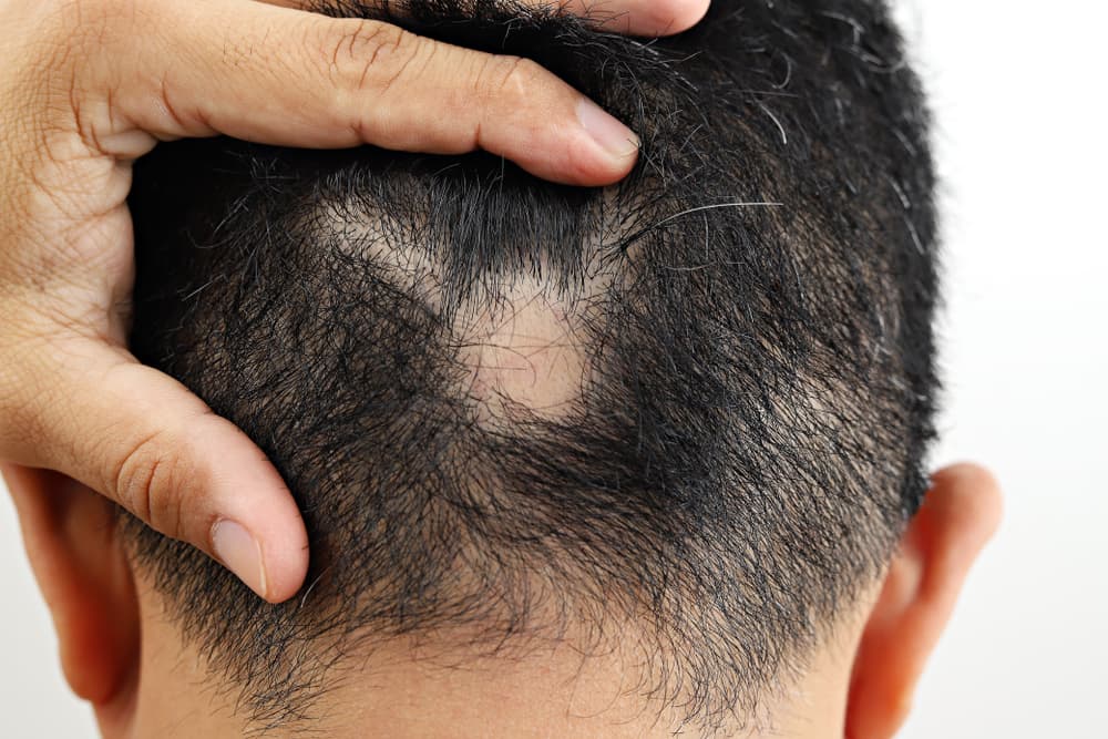 Man,With,Alopecia,Areata,On,Head.,Spot,Baldness.,Male,Alopecia