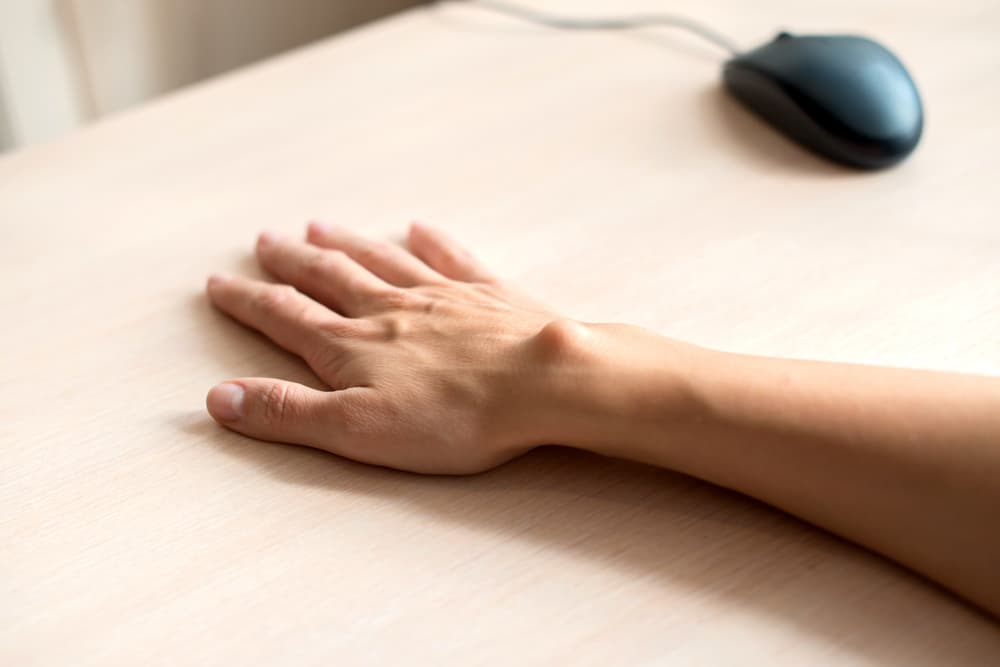 Female,Hand,With,A,Hygroma.,Pain.,Wrist,Ganglion,Cyst.,Computer