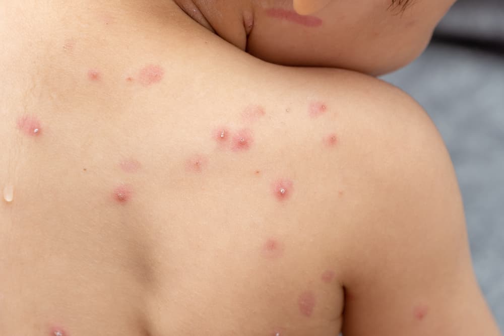 Treatment,Of,Ulcers,From,Chickenpox,,Varicella,With,Medical,Cream,On