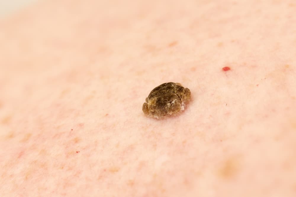 Seborrheic,Keratosis,Also,Known,As,Seborrheic,Verruca,Or,A,Senile