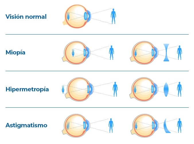 La visión normal enfoca claramente objetos a diferentes distancias. La miopía dificulta ver de lejos, mientras que la hipermetropía obstaculiza la visión de cerca. El astigmatismo causa distorsiones a todas las distancias. La visión normal enfoca claramente objetos a diferentes distancias. La miopía dificulta ver de lejos, mientras que la hipermetropía obstaculiza la visión de cerca. El astigmatismo causa distorsiones a todas las distancias.