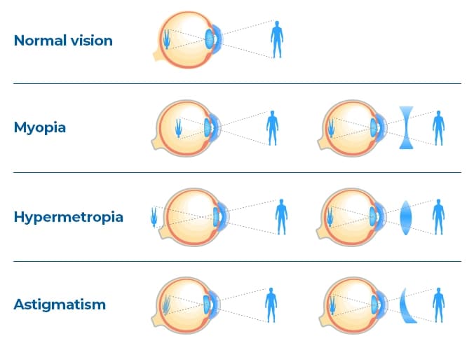 Normal vision clearly focuses on objects at different distances. Myopia makes it difficult to see far away, while hyperopia hinders near vision. Astigmatism causes distortions at all distances. Normal vision clearly focuses on objects at different distances. Myopia makes it difficult to see far away, while hyperopia hinders near vision. Astigmatism causes distortions at all distances.