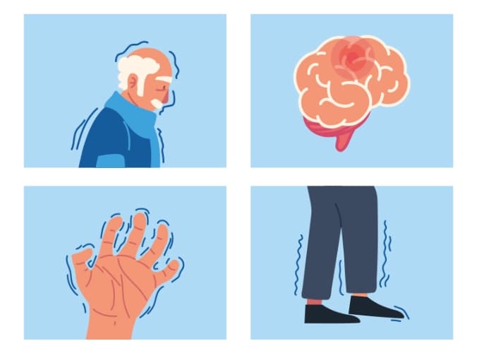 Ilustración de perfil humano, cerebro, manos y piernas con signos de Parkinson. Ilustración de perfil humano, cerebro, manos y piernas con signos de Parkinson.