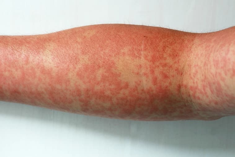 Pele do braço com manchas vermelhas, sintoma da dengue Pele do braço com manchas vermelhas, sintoma da dengue