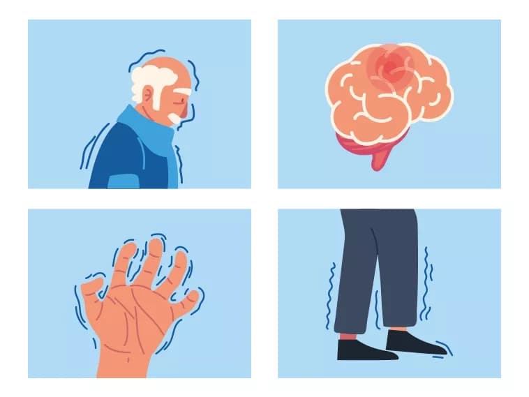 Illustration of human profile, brain, hand and legs with signs of Parkinson's Illustration of human profile, brain, hand and legs with signs of Parkinson's