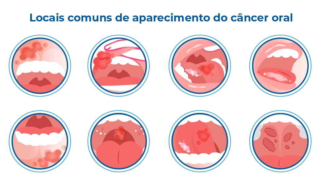 Ilustração que mostra os locais comuns de aparecimento do câncer oral, que abrange a região da boca e garganta: bochechas internas, gengivas, parte interna dos lábios, palato ou céu da boca, amígdalas, língua, base da língua e assoalho da boca Ilustração que mostra os locais comuns de aparecimento do câncer oral, que abrange a região da boca e garganta: bochechas internas, gengivas, parte interna dos lábios, palato ou céu da boca, amígdalas, língua, base da língua e assoalho da boca
