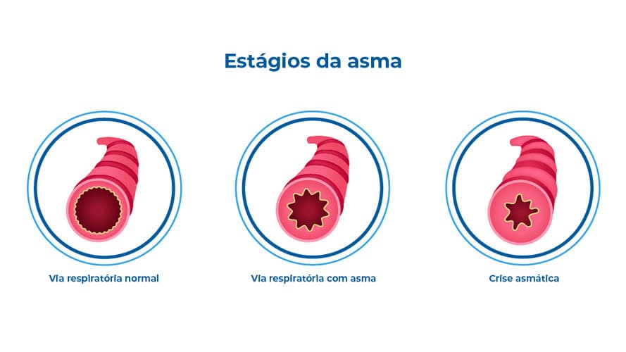 Infográfico mostra estágios da asma, inflamação nas vias respiratórias: normal, com asma e crise asmática. Em destaque, brônquios inflamados, que podem causar falta de ar, chiado no peito e tosse persistente. Infográfico mostra estágios da asma, inflamação nas vias respiratórias: normal, com asma e crise asmática. Em destaque, brônquios inflamados, que podem causar falta de ar, chiado no peito e tosse persistente.