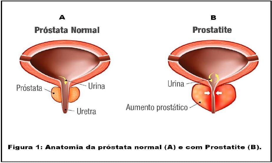 Figura 1: Anatomia da próstata normal (A) e com Prostatite (B). Figura 1: Anatomia da próstata normal (A) e com Prostatite (B).