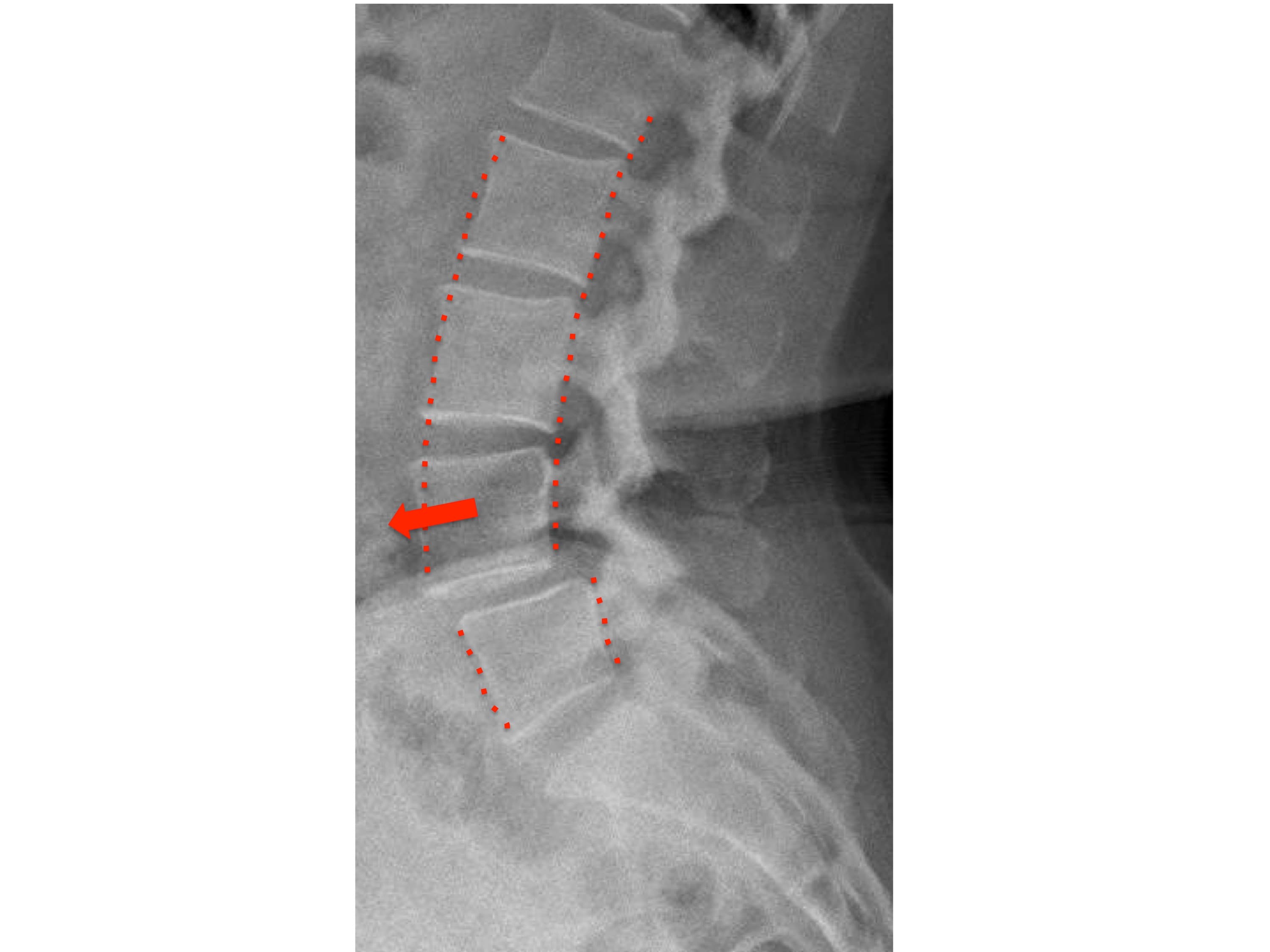 Exame de imagem da coluna vertebral para a confirmação do diagnóstico de espondilolistese. É possível observar na ressonância magnética a indicação da localização do problema. Exame de imagem da coluna vertebral para a confirmação do diagnóstico de espondilolistese. É possível observar na ressonância magnética a indicação da localização do problema.