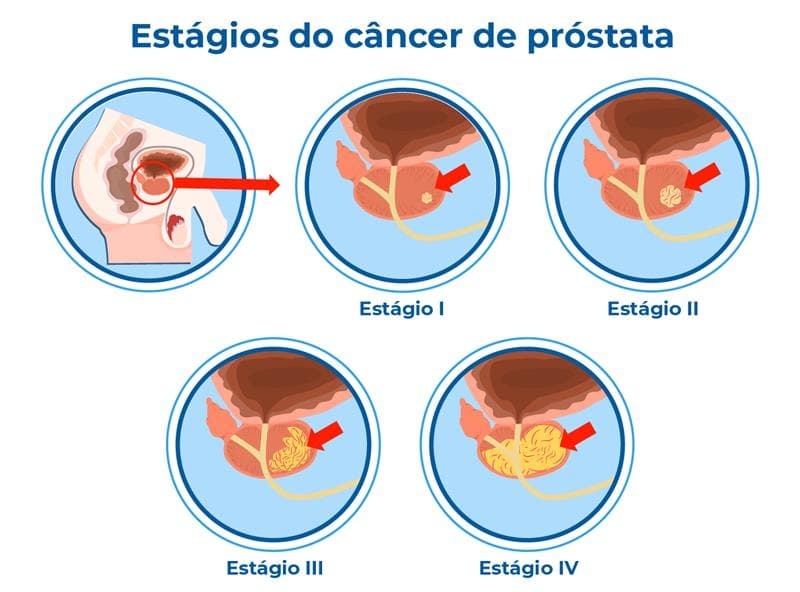 Infográfico mostra os estágios do câncer de próstata: estágio I com tumor pequeno, estágio II com tumor maior, estágio III com crescimento além da próstata e estágio IV com metástase. Entenda os estágios e os impactos dessa doença masculina Infográfico mostra os estágios do câncer de próstata: estágio I com tumor pequeno, estágio II com tumor maior, estágio III com crescimento além da próstata e estágio IV com metástase. Entenda os estágios e os impactos dessa doença masculina