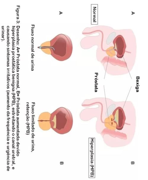 Figura 3: Desenho: A= Próstata normal, B= Próstata aumentada devido hiperplasia prostática benigna (HPB), estreitando o canal uretral, e causando sintomas irritativos (aumento da frequência e urgência de urinar). Figura 3: Desenho: A= Próstata normal, B= Próstata aumentada devido hiperplasia prostática benigna (HPB), estreitando o canal uretral, e causando sintomas irritativos (aumento da frequência e urgência de urinar).