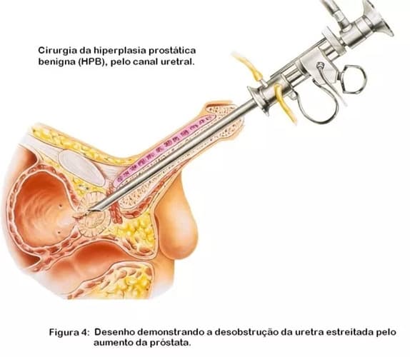 Figura 4: Desenho demonstrando a desobstrução da uretra estreitada pelo aumento da próstata. Figura 4: Desenho demonstrando a desobstrução da uretra estreitada pelo aumento da próstata.