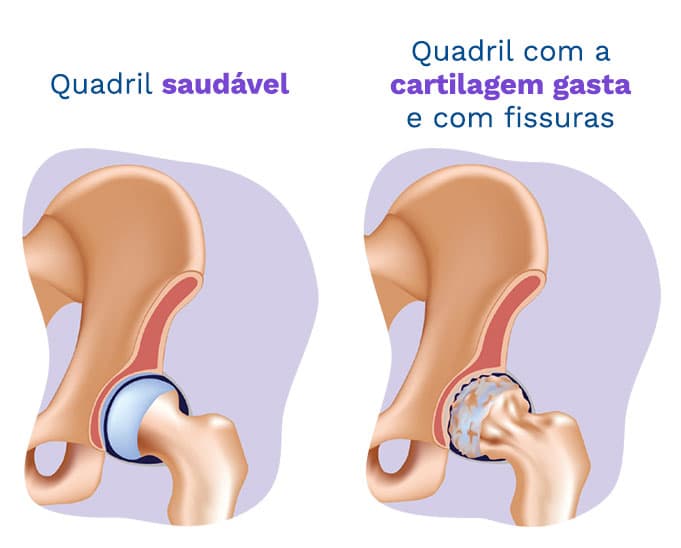 A ilustração apresenta as diferenças entre um quadril saudável e um quadril com a cartilagem gasta e fissuras, caracterizando a artrose do quadril. A ilustração apresenta as diferenças entre um quadril saudável e um quadril com a cartilagem gasta e fissuras, caracterizando a artrose do quadril.