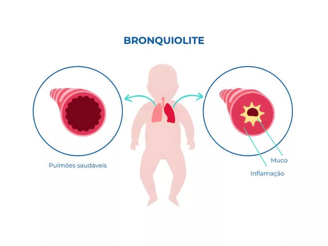 Ilustração que compara pulmão direito de bebê com bronquiolite ao esquerdo, que está saudável Ilustração que compara pulmão direito de bebê com bronquiolite ao esquerdo, que está saudável