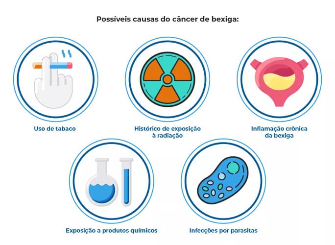 Infográfico sobre possíveis causas do câncer de bexiga, que incluem: uso de tabaco, exposição à radiação, inflamação crônica da bexiga e presença de sangue na urina, exposição a produtos químicos, e infecções por parasitas. Cada causa é representada por um ícone Infográfico sobre possíveis causas do câncer de bexiga, que incluem: uso de tabaco, exposição à radiação, inflamação crônica da bexiga e presença de sangue na urina, exposição a produtos químicos, e infecções por parasitas. Cada causa é representada por um ícone